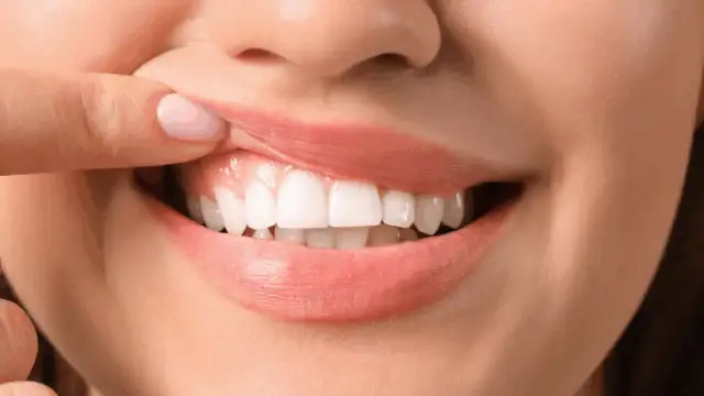 Przeszczep dziąsła: czy warto? Koszty, ból, efekty, alternatywy