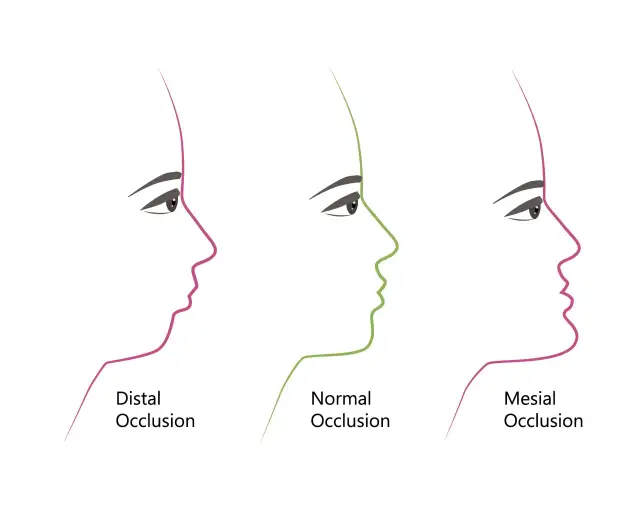 Metamorfoza twarzy po aparacie: Profil, usta, żuchwa co się zmieni?