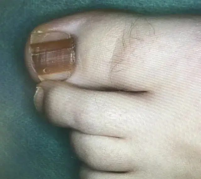 Jak wygląda rak paznokcia? Objawy, które mogą cię zaniepokoić