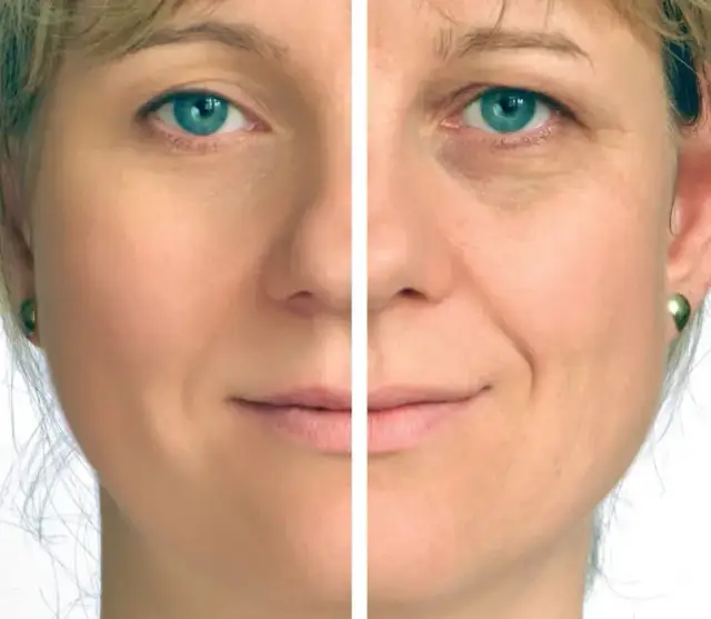 Alternatywy dla botoksu: Skuteczne metody na gładkie czoło