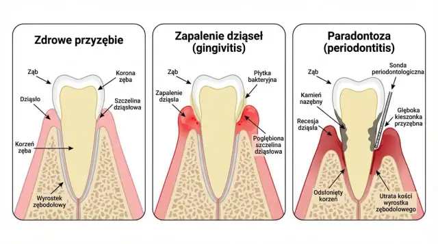 Ilustracja pokazuje postęp chorób przyzębia: zdrowe dziąsła, zapalenie dziąseł i paradontozę. Czy paradontoza jest zaraźliwa?