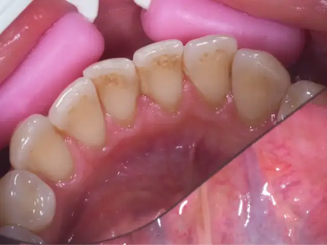 Jak wygląda kamień na zębach? Objawy i skutki zdrowotne