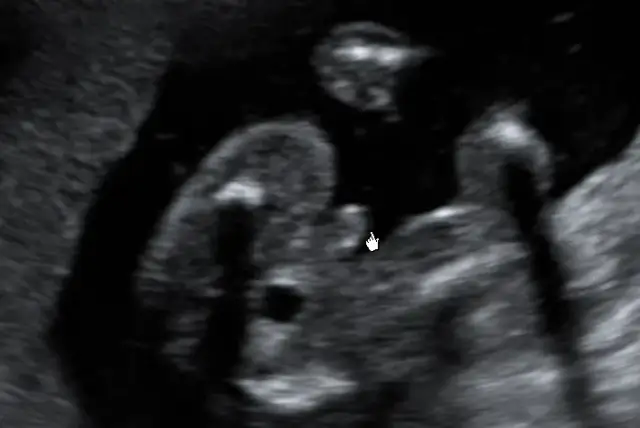 Czy w 16 tygodniu ciąży naprawdę widać płeć dziecka? Sprawdź, co mówią badania USG