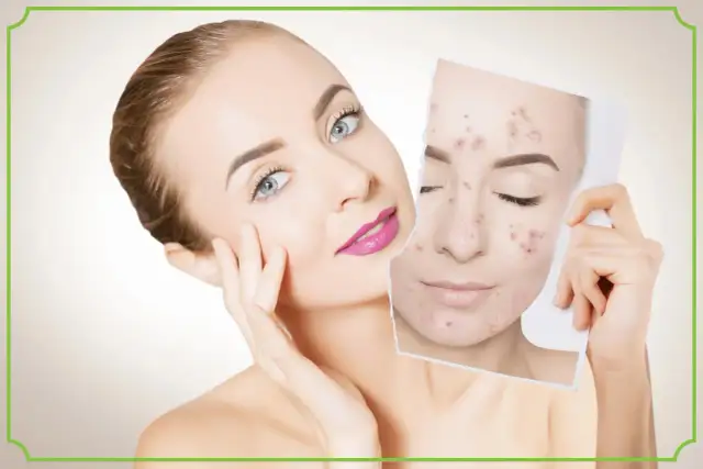 Co na pryszcze? Skuteczne sposoby i składniki aktywne