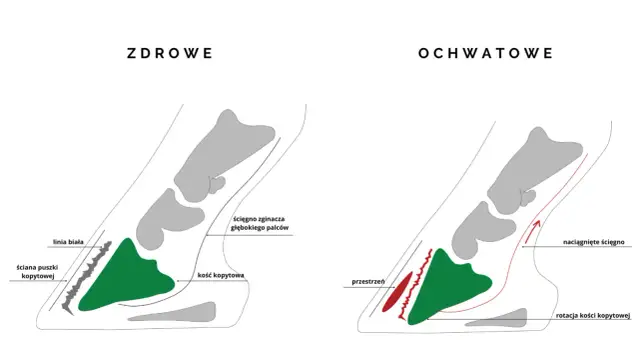 Zdrowe i ochwatowe kopyto konia. Ilustracja pokazuje rotację kości kopytowej i naciągnięte ścięgno w przypadku ochwatu.