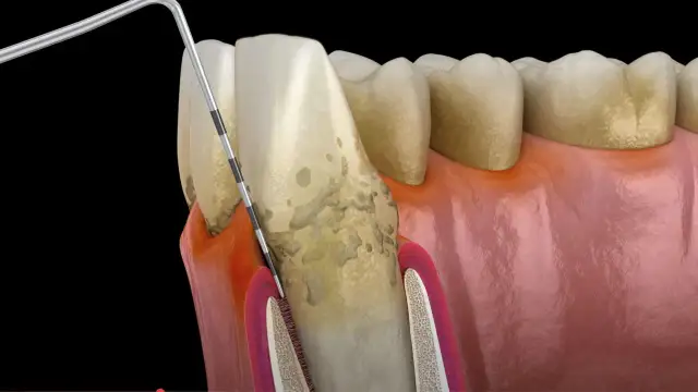 Narzędzie dentystyczne bada głęboką dziurę w zębie, odsłaniając kamień nazębny i stan zapalny dziąseł.