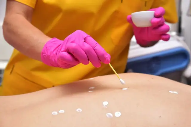 Maść cynkowa na pryszcze: Czy wiesz, jak ją stosować, by zadziałała?