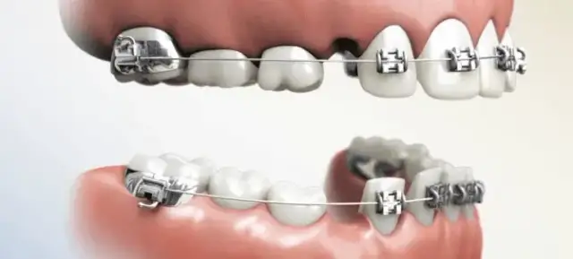 Aparat na zęby: Kto zakłada i jak wybrać najlepszego ortodontę?