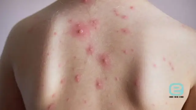 Ospa wietrzna: Kontakt? Działaj szybko! Skuteczna profilaktyka
