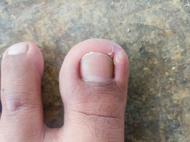 Jak leczyć wrastający paznokieć? Domowe sposoby i profesjonalne zabiegi