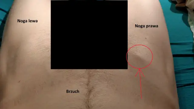 Powiększone węzły chłonne pachwinowe: Do lekarza rodzinnego! Co dalej?