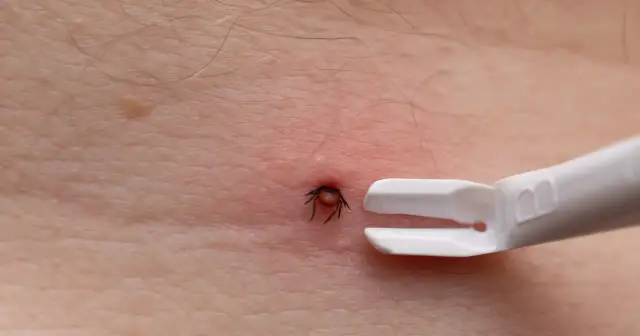 Urwany kleszcz w skórze? Rozpoznaj resztki i działaj krok po kroku
