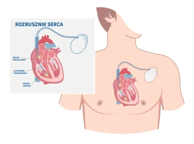 Skutki uboczne po wszczepieniu rozrusznika serca – najważniejsze informacje i objawy.