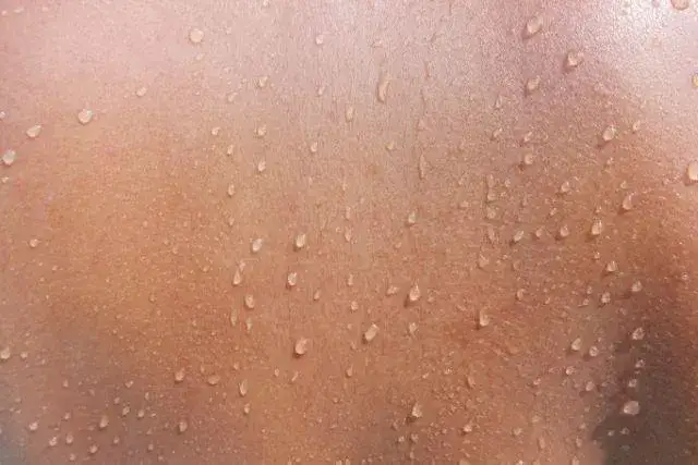 Zimne poty objawy: co mogą oznaczać i kiedy się martwić