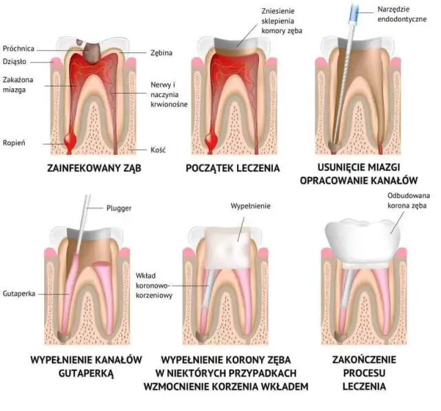 Ile naprawdę kosztuje leczenie kanałowe zębów i jak uniknąć wysokich rachunków