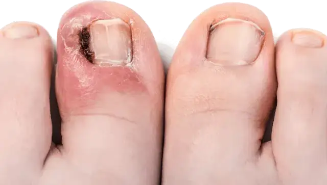 Wrastający paznokieć: Jak leczyć w domu i kiedy do podologa?