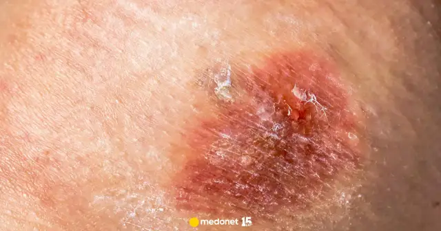 Kwas z akumulatora na skórze? Ratuj zdrowie! Pierwsza pomoc