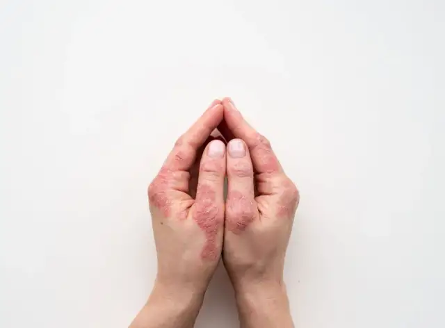 Łuszczyca dłoni: Jak rozpoznać 5 kluczowych objawów?