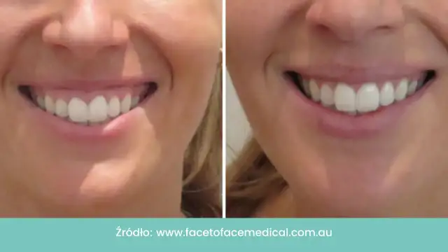 Czy Twoje dziąsła rosną? Rozpoznaj przerost i zadbaj o uśmiech