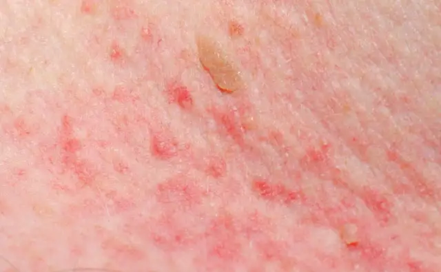 Skuteczne leki na asfaltówkę: ulga w objawach choroby pielgrzyma