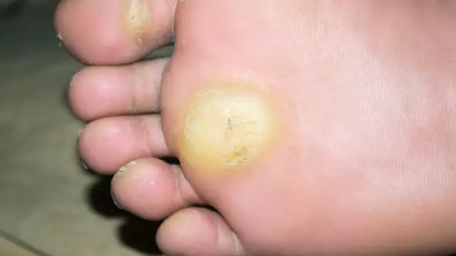 Czy po usunięciu modzela można chodzić? Odpowiedzi na Twoje wątpliwości