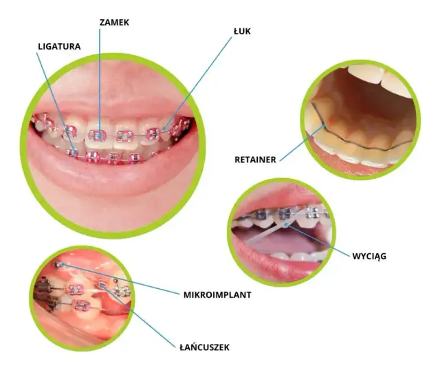 Kto zakłada aparat na zęby? Wybierz ortodontę i lecz bezpiecznie