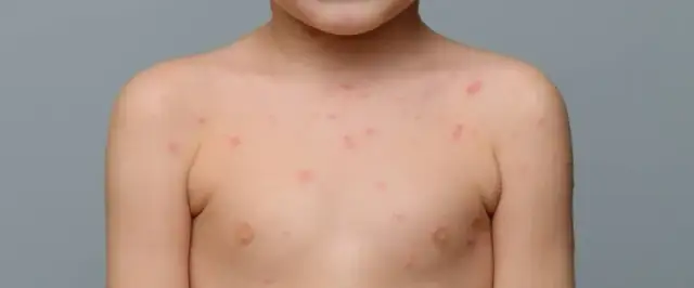 Kiedy do lekarza przy ospie? Kluczowe objawy, które musisz znać