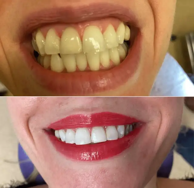 Wybielanie zębów u dentysty: Koszt, efekty i bezpieczeństwo. Poznaj fakty.