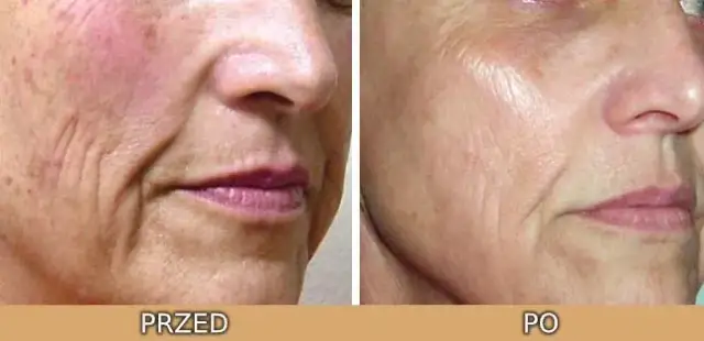 Jak długo goi się skóra po laserze frakcyjnym? Poznaj fakty