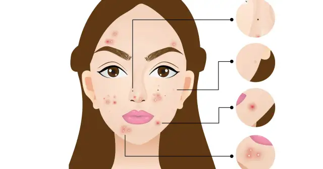 Ilustracja pokazuje twarz z pryszczami i powiększone detale różnych zmian skórnych. Pryszcze na twarzy znaczenie mogą mieć różne, od diety po hormony.