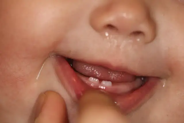 Ząbkowanie górnych jedynek: Co zobaczysz na dziąsłach? Poradnik