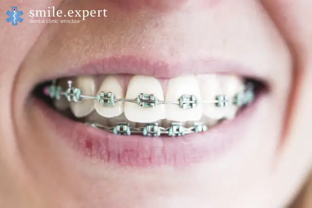 Ile kosztuje aparat? Poradnik: Wybierz mądrze, nie przepłacaj!