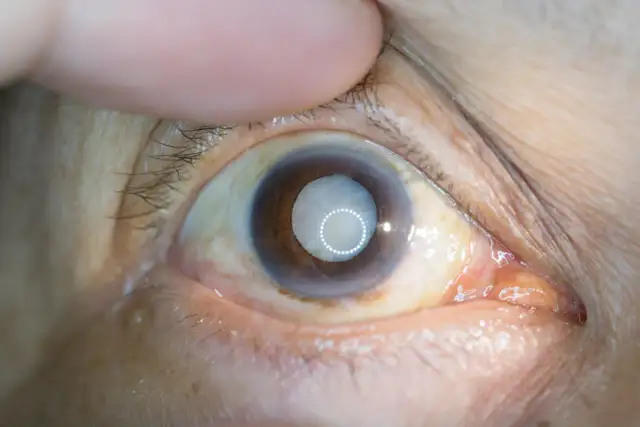 Objawy zaćmy: Kiedy świat traci barwy? Co musisz wiedzieć