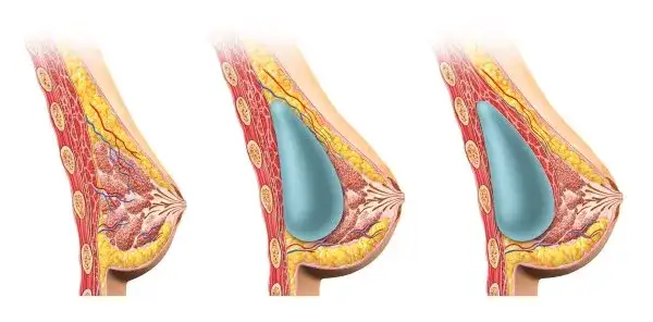 Implanty 325 ml jaki to rozmiar i jak wpłyną na Twój wygląd