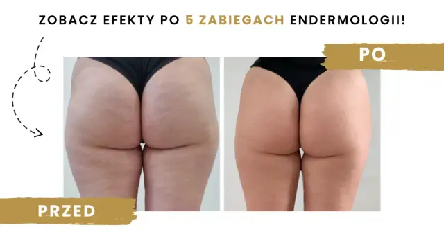 Endermologia: co to, jak działa i czy warto? Pełny przewodnik