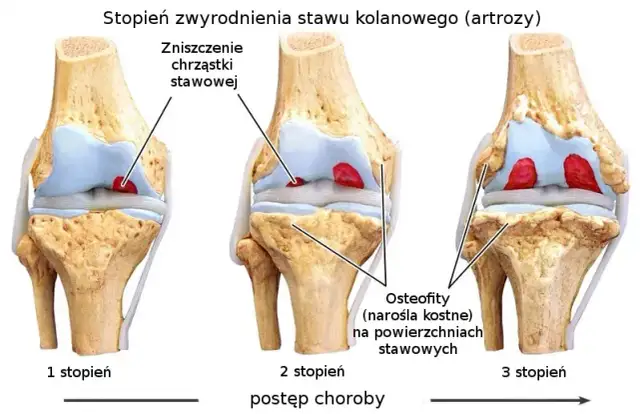 Skuteczne metody na ból kolana przy zmianach zwyrodnieniowych