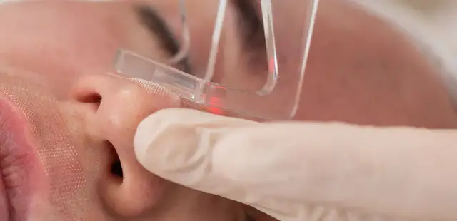 Jak działa laser frakcyjny? Sekrety skutecznej regeneracji skóry