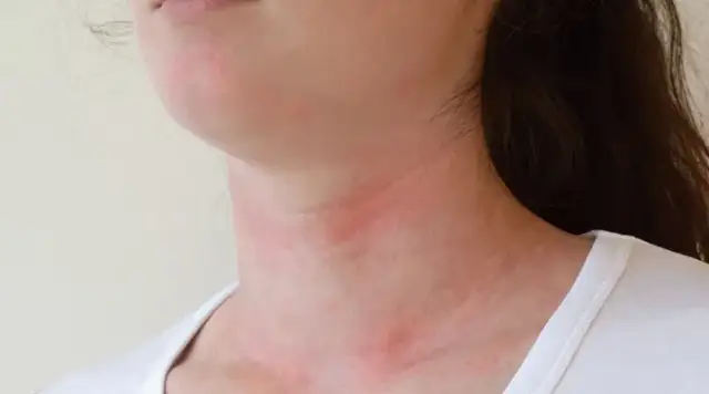 Alergia na pomidory: objawy, krzyżówki i nietolerancja histaminy