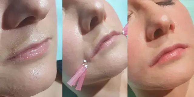 Powiększanie ust: Kiedy efekt? Ostateczny wygląd po 2-4 tyg.