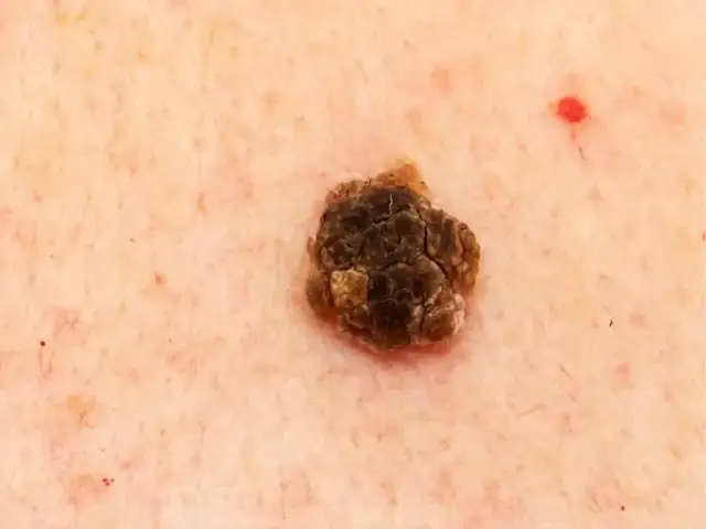 Czy brodawka łojotokowa odpadnie? Fakty, które warto znać