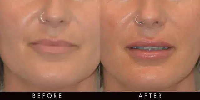 Czy 1 ml kwasu hialuronowego to dużo? Poznaj skutki i zastosowania