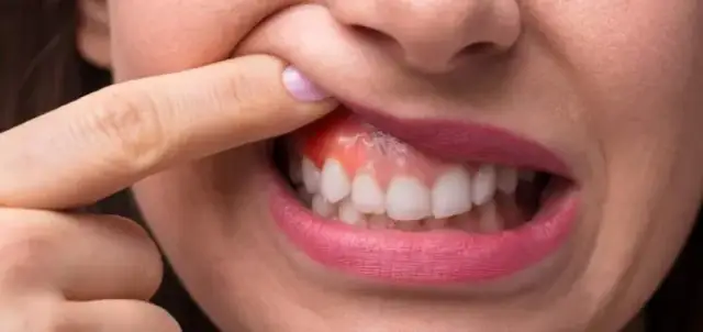 Skuteczne sposoby na opuchnięte dziąsła – domowe metody i leki bez recepty