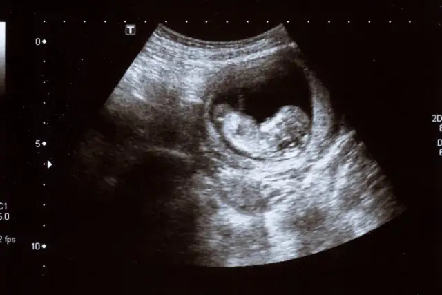 Kiedy słychać bicie serca dziecka? Sprawdź, co musisz wiedzieć