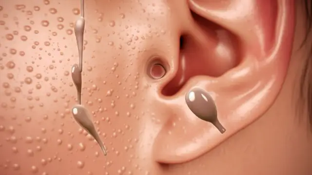 Jak usunąć wągry z ucha? Porady i triki na zaskórniki w uchu