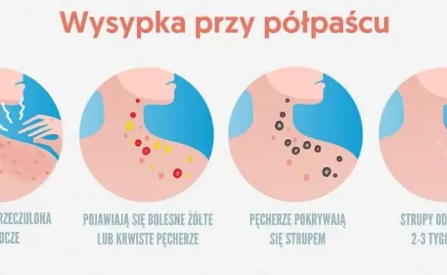 Półpasiec objawy u dziecka: Jak rozpoznać i uniknąć powikłań