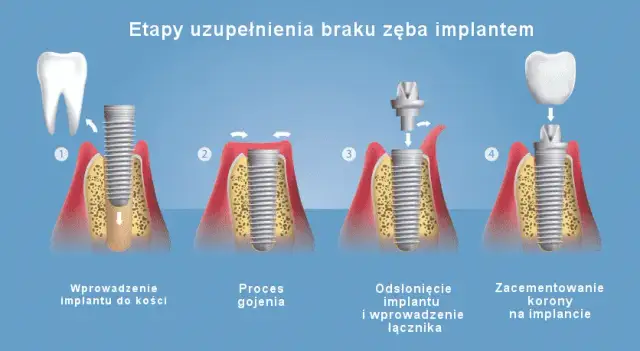 Jak wygląda implant zęba? Wszystko o budowie i procesie wszczepiania