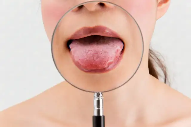 Krosta na języku - przesądy i znaczenie