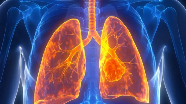 Guz w płucach: Co oznaczają guzy w płucach?