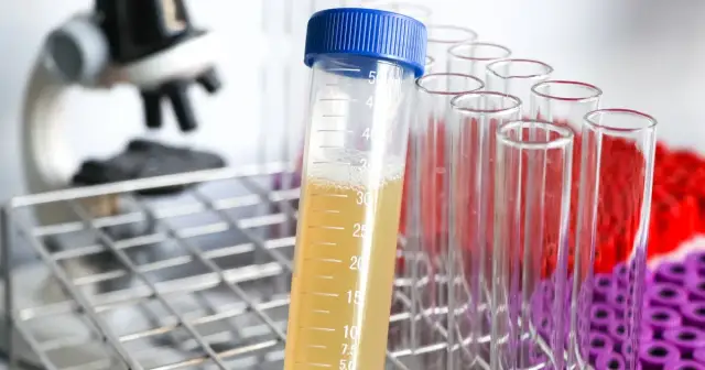 Czego nie robić przed badaniem moczu, aby uniknąć błędnych wyników