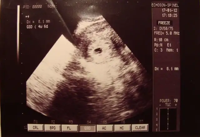 Jak wygląda dziecko w 5 tyg ciąży? Zaskakujący rozwój zarodka